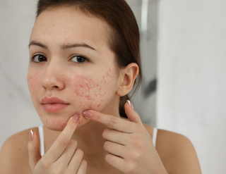 Acne Dos and Don’ts