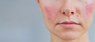 Banana Sap, IL-8, and Eczema: What the Science Actually Shows