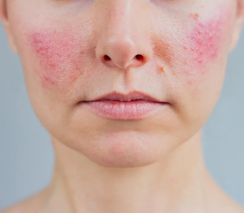 You've tried everything. Your skin is still reacting.